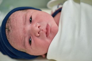 孕期妊娠合并新生儿Turner综合征怎么生长激素？